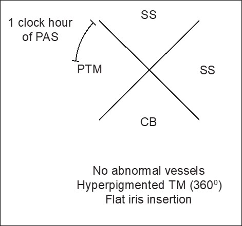 Figure 3.1.4 Documenting the Anterior Chamber Angle