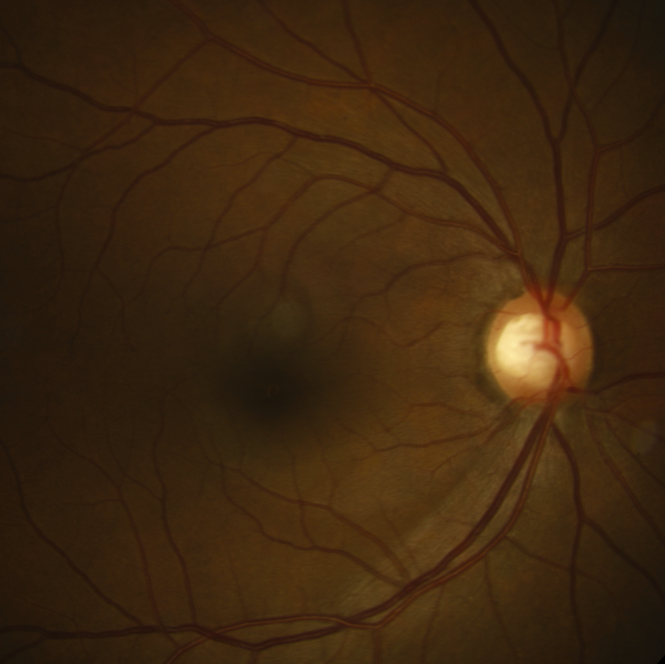 Figure 3.1.6 Inferotemporal Retinal Nerve Fibre Layer Defect