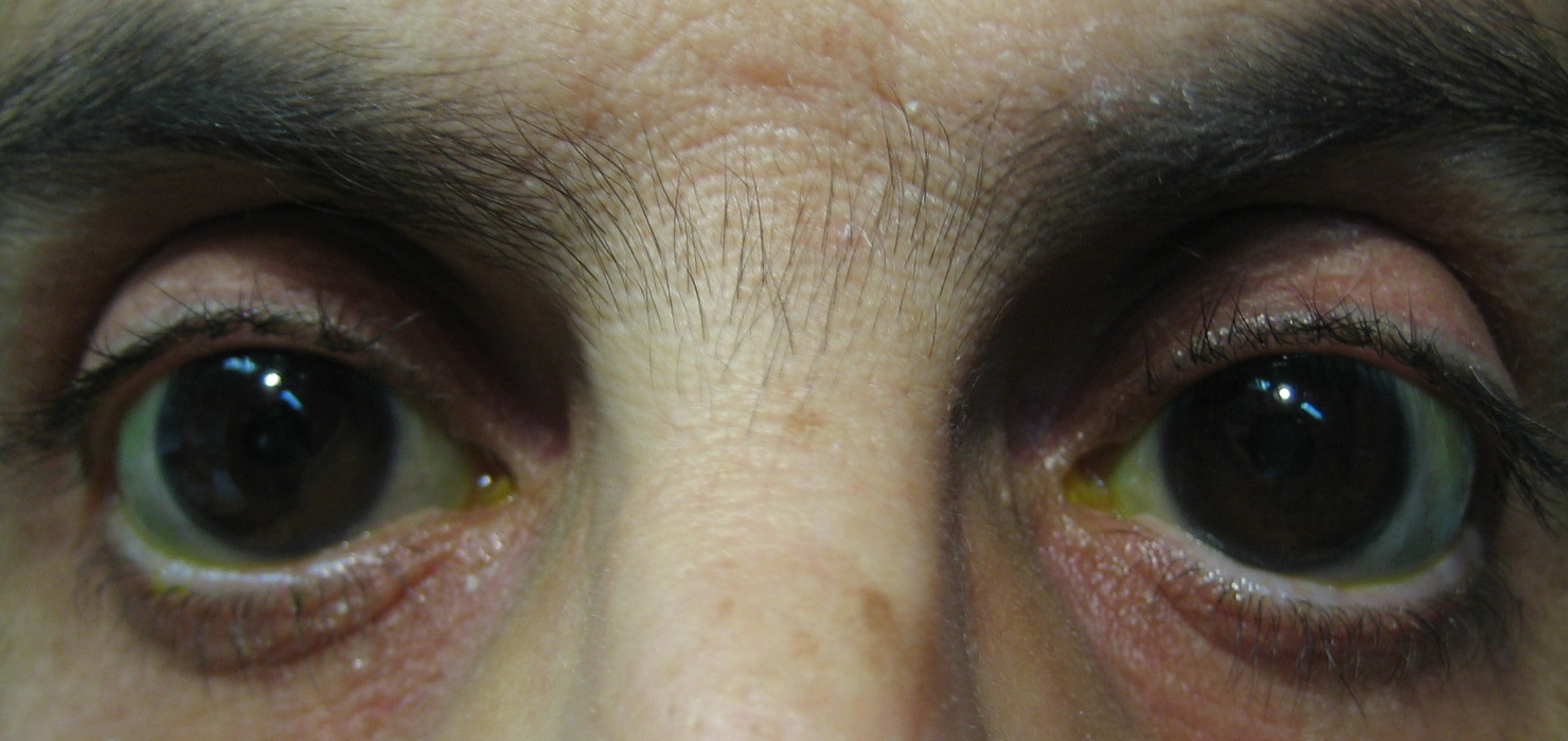 Figure 3.2.1 Childhood Glaucoma: Buphthalmos