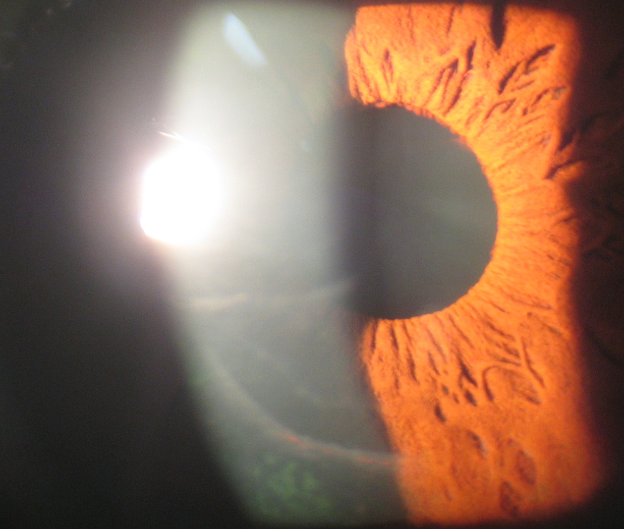 Figure 3.2.2 Childhood Glaucoma: Haab Striae