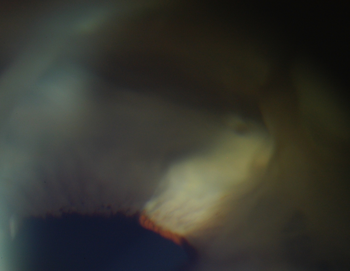 Figure 3.2.3 Childhood Glaucoma: Iridocorneal Adhesions in Peter’s Anomaly