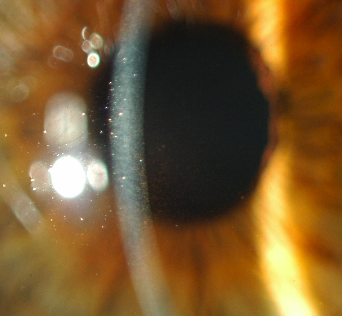 Figure 3.2.6
Krukenberg Spindle in Pigment Dispersion Syndrome