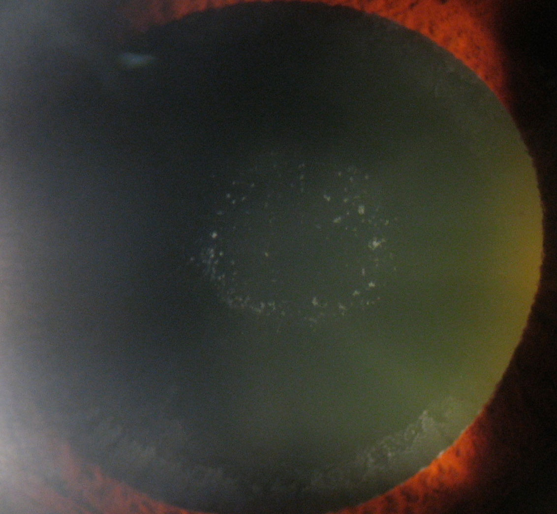 Figure 3.2.7 Hoarfrost Ring in Pseudoexfoliation Syndrome