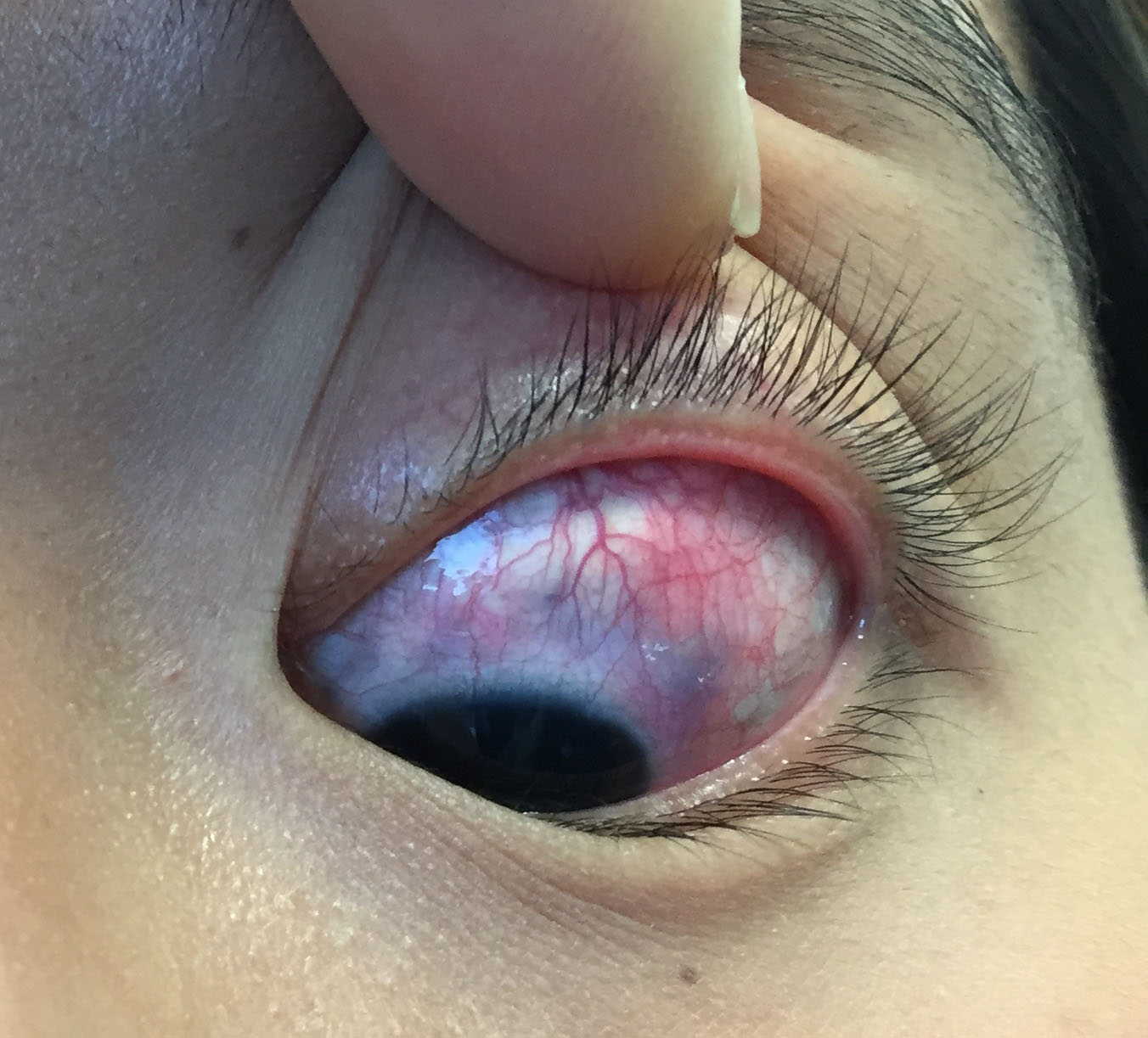 Figure 4.1.1 Scleritis