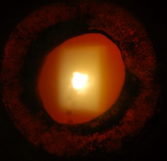 Figure 4.1.3 Herpetic Uveitis