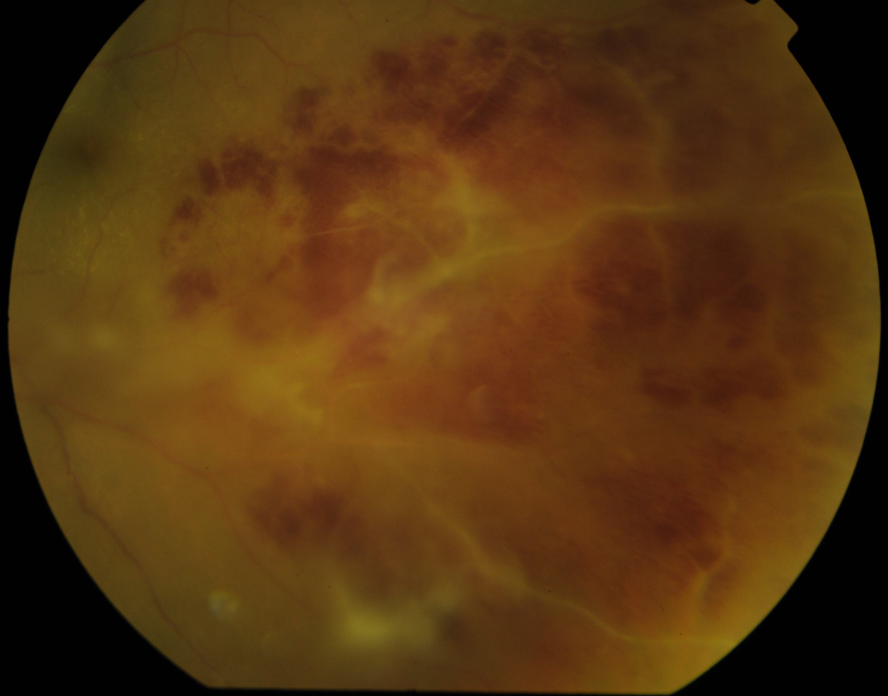 Figure 4.2.3 Periphlebitis and Branch Retinal Vein Occlusion Secondary to Toxoplasmosis Uveitis