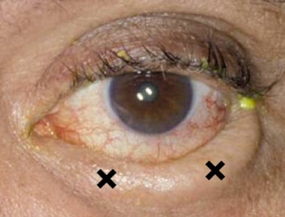 Figure 5.2.3 Botox for Entropion