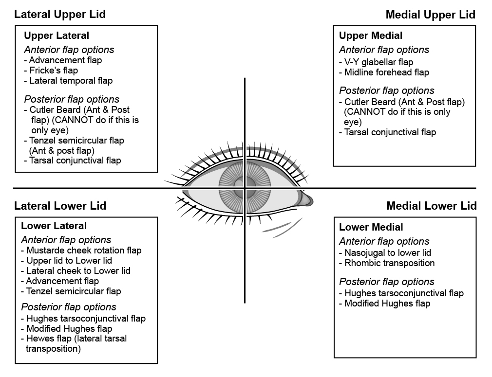 Figure 5.3.1 Anterior and Posterior Flap Options for the Various Locations of the Lid
