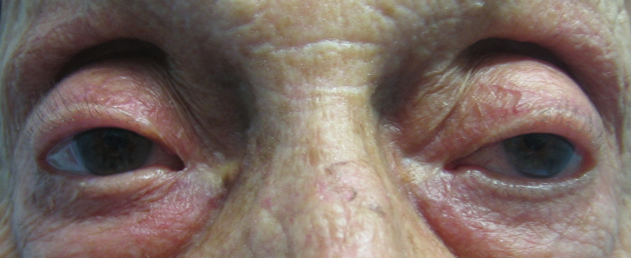 Figure 5.4.1 Aponeurotic Ptosis