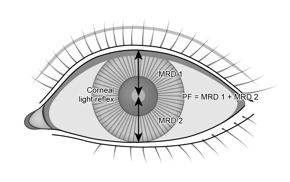 Figure 5.4.4 Ptosis Measurements