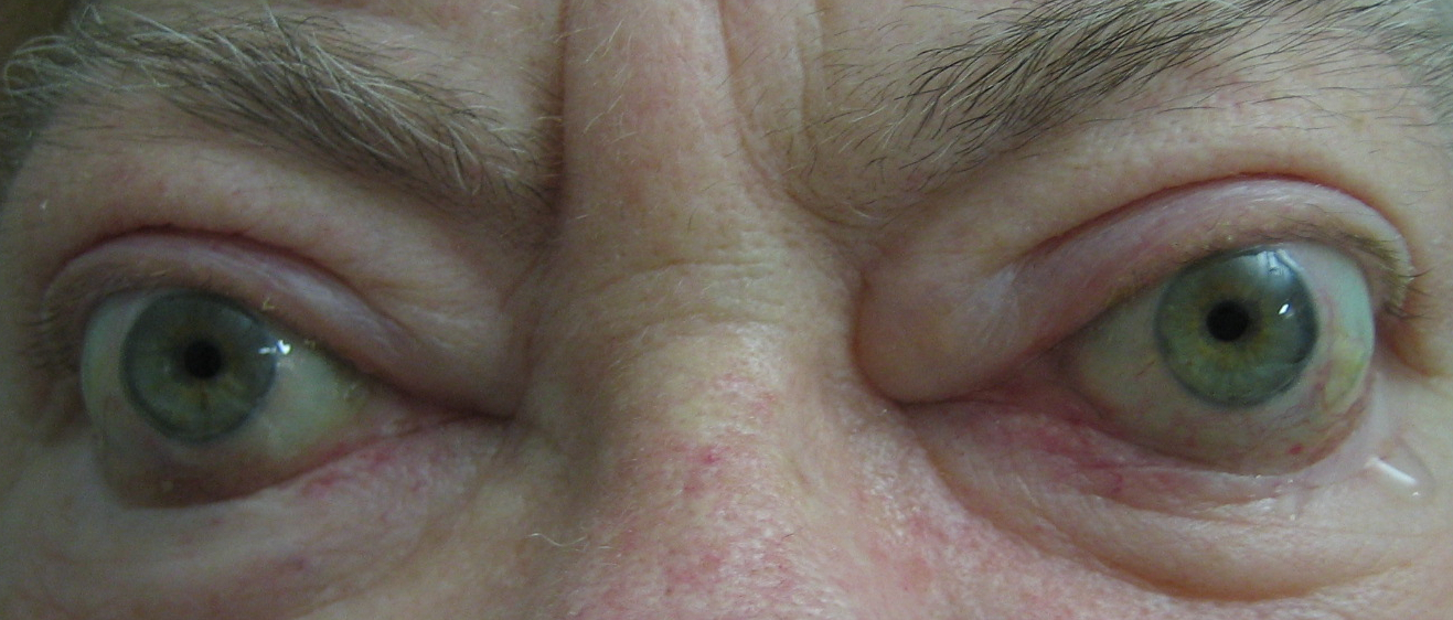 Figure 5.6.1 Thyroid Eye Disease with Bilateral Proptosis