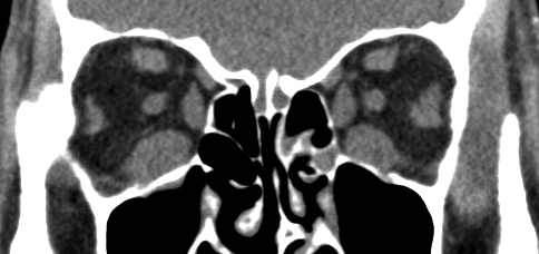 Figure 5.6.2 Extra-ocular Muscle Swelling in Thyroid Eye Disease