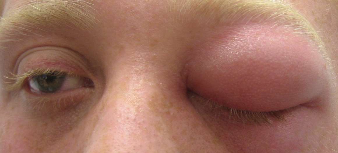 Figure 5.7.3 Left Orbital Cellulitis