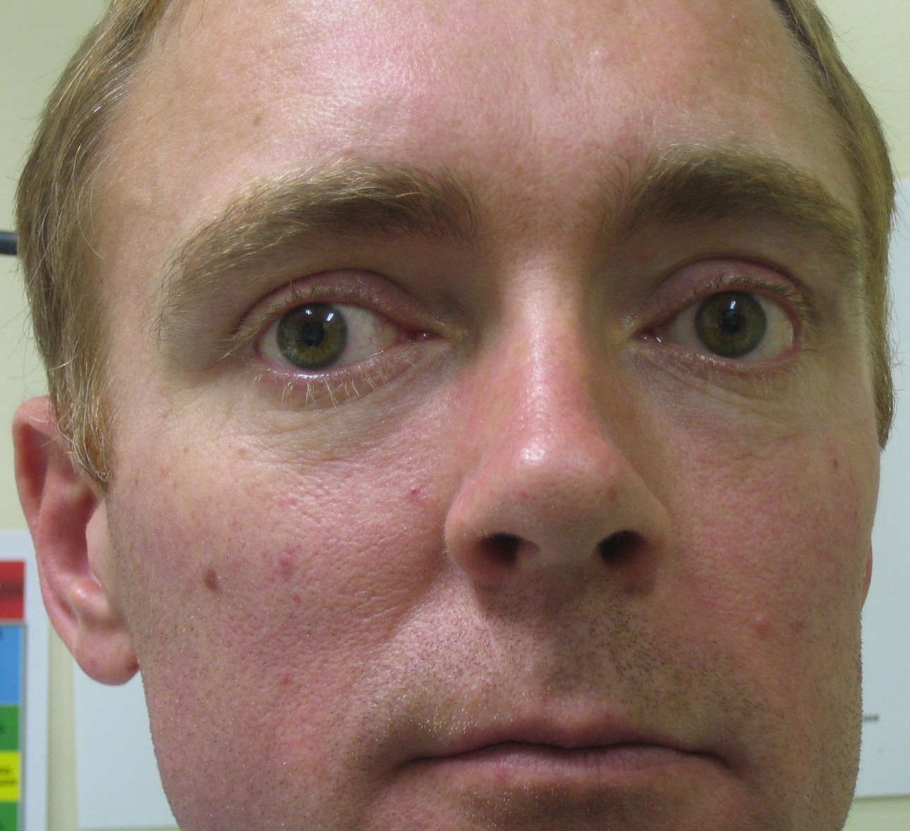 Figure 6.10.1 Consecutive Exotropia