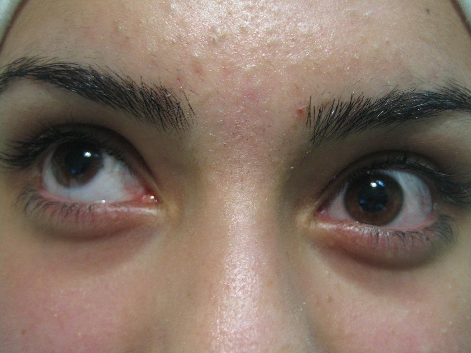 Figure 6.8.1 Left Brown Syndrome