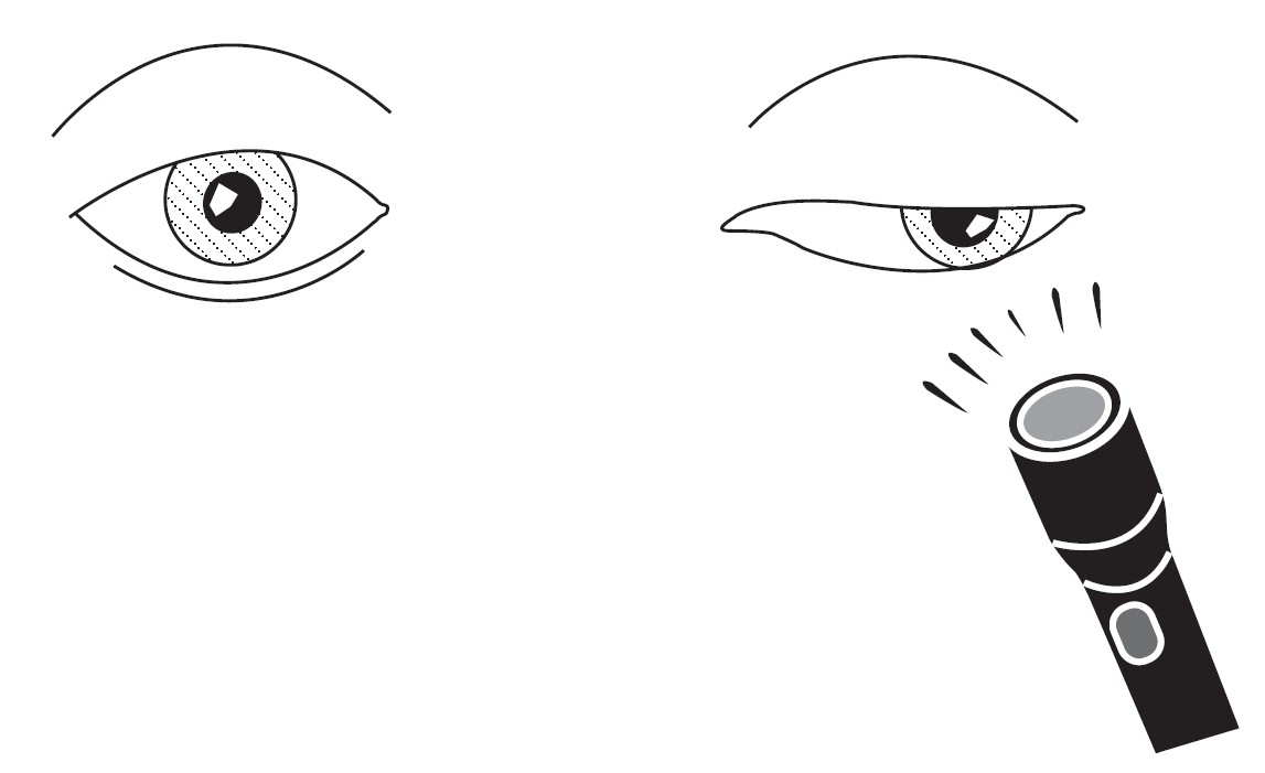 Figure 7.1.1 Left CNIII Palsy