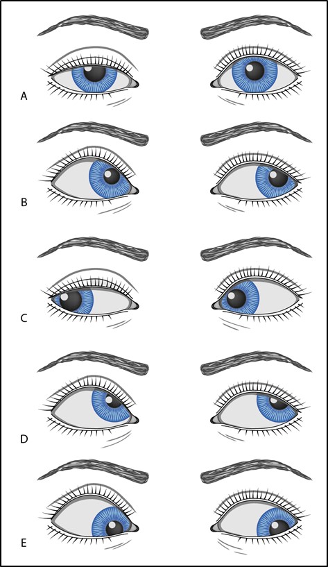 Figure 7.1.2 Right Cranial Nerve III Palsy with Aberrant Regeneration