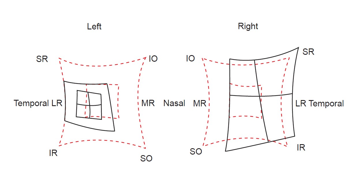 Figure 7.1.3 Hess Chart of Left CNIII Palsy