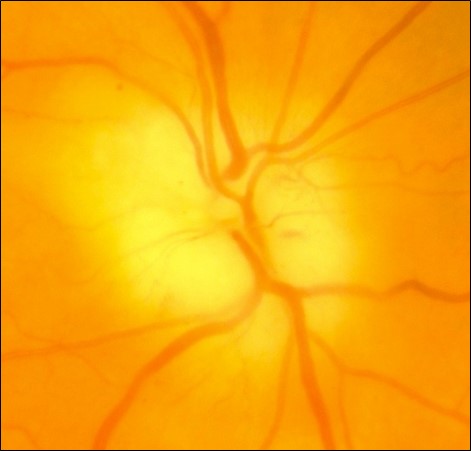 Figure 7.10.1 Arteritic Anterior Ischaemic Optic Neuropathy