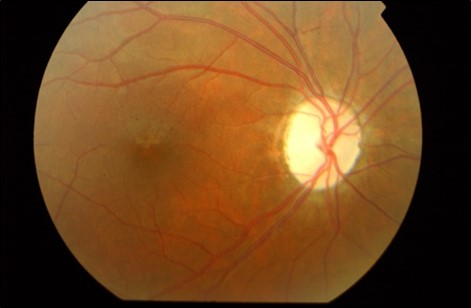 Figure 7.10.2 Right Optic Atrophy