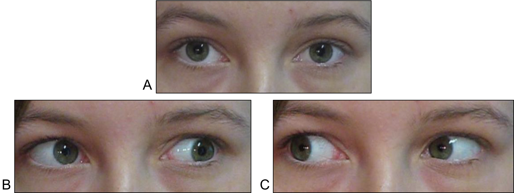 Figure 7.2.1 Right CNIV Palsy