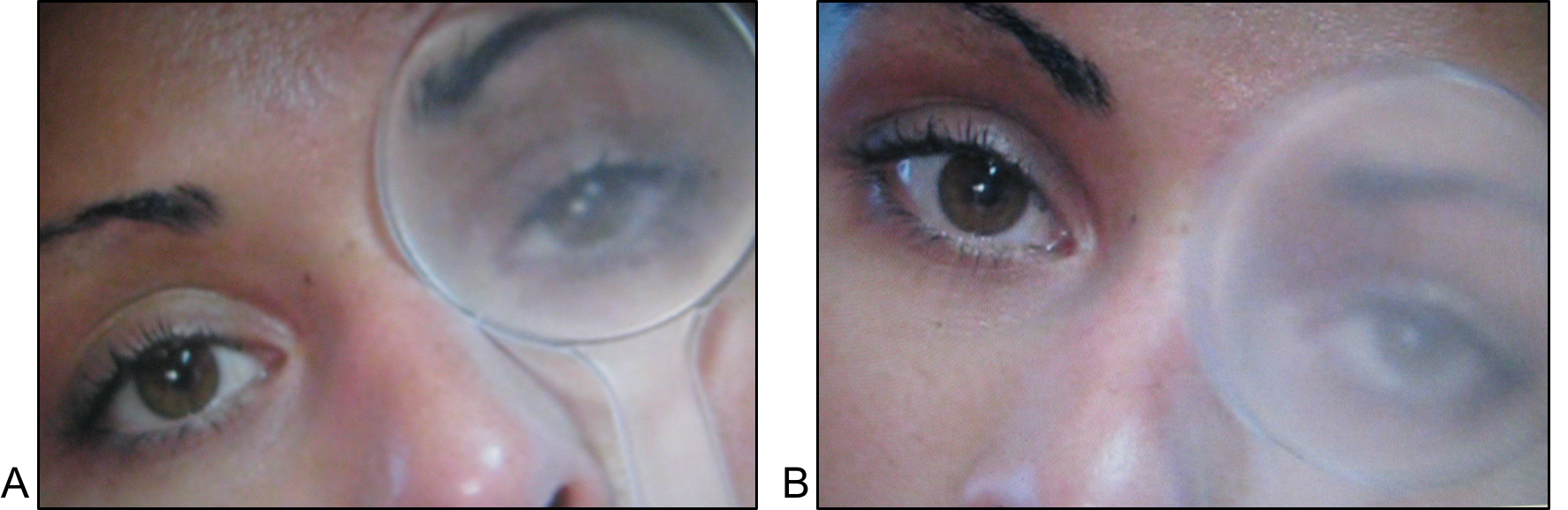 Figure 7.2.2 Left CNIV Palsy