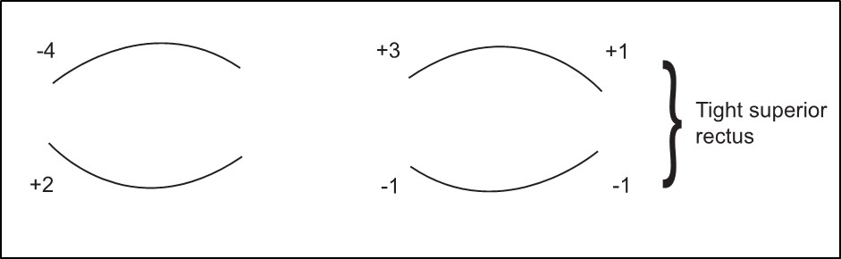 Figure 7.2.4 Typical Sequelae of a Left CNIV Palsy When Testing Versions