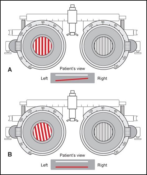 Figure 7.2.4 Typical Sequelae of a Left CNIV Palsy When Testing Versions