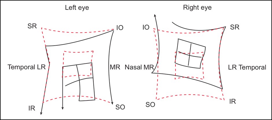 Figure 7.2.6 Hess Chart of Acquired Right CNIV Palsy