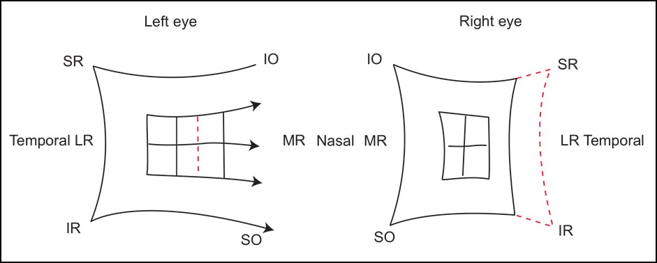 Figure 7.3.2 Hess Chart of Right CNVI Palsy