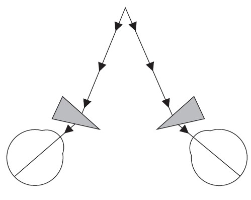 Figure 7.3.3 Base Out Prism for Esotropia in CNVI Palsy