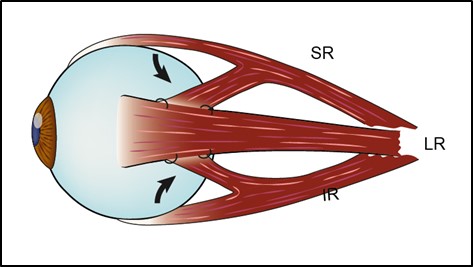 Figure 7.3.4 Transposition of Superior Rectus and Inferior Rectus to Lateral Rectus for Complete CNVI Palsy