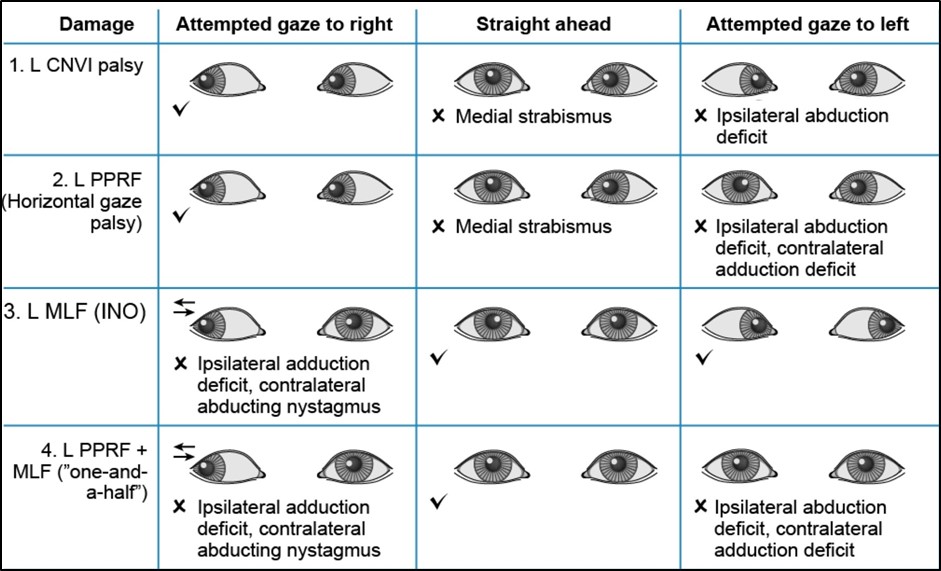Figure 7.3.8 Clinical Outcomes of Different Lesions Affecting Horizontal Eye Movements
