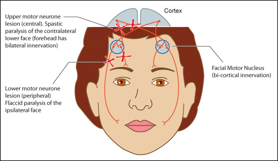 Figure 7.4.3 Upper versus Lower Motor Neurone CNVII Palsies