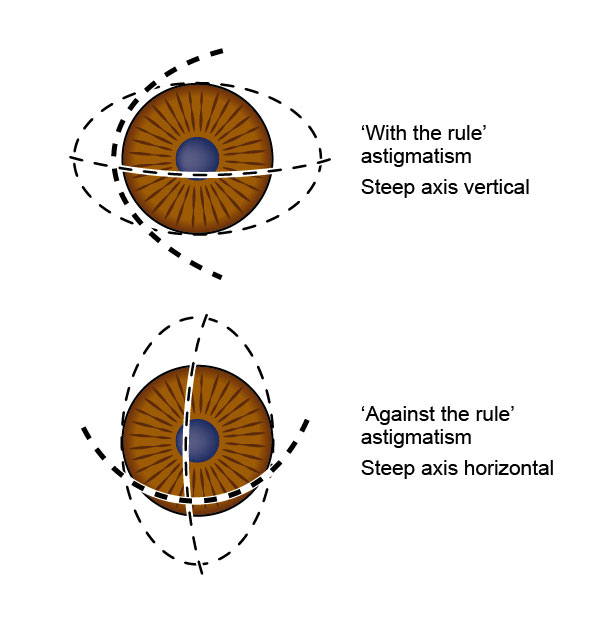 Figure 9.1.2 With and Against the Rule Astigmatism