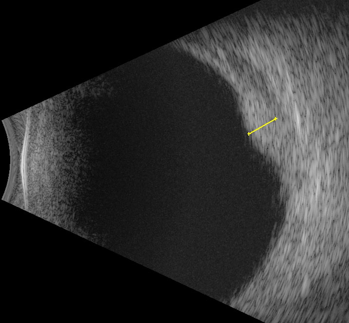 Figure 9.10.10 B-scan of Choroidal Haemangioma