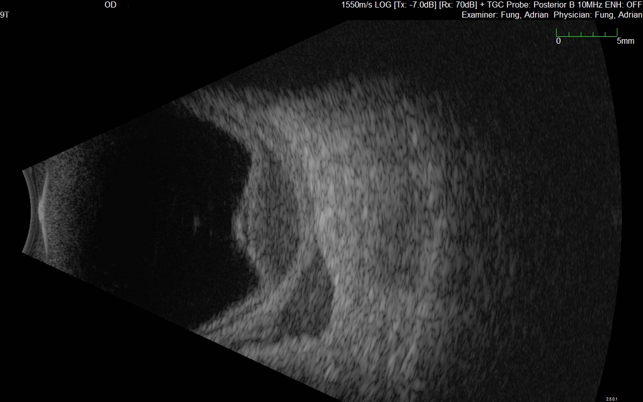 Figure 9.10.11 B-scan of Choroidal Lymphoma
