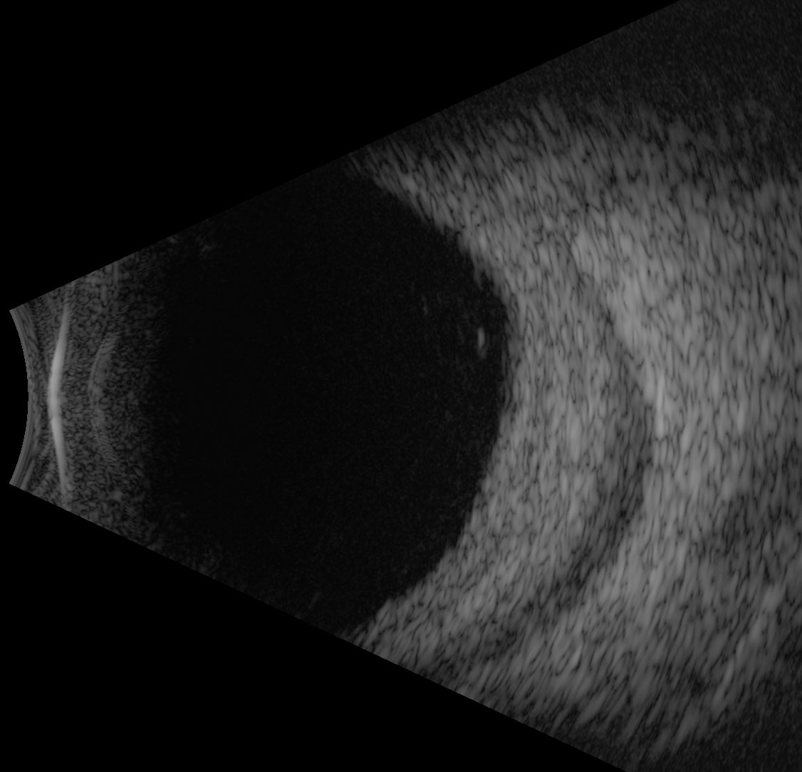 Figure 9.10.12 B-scan of posterior scleritis 