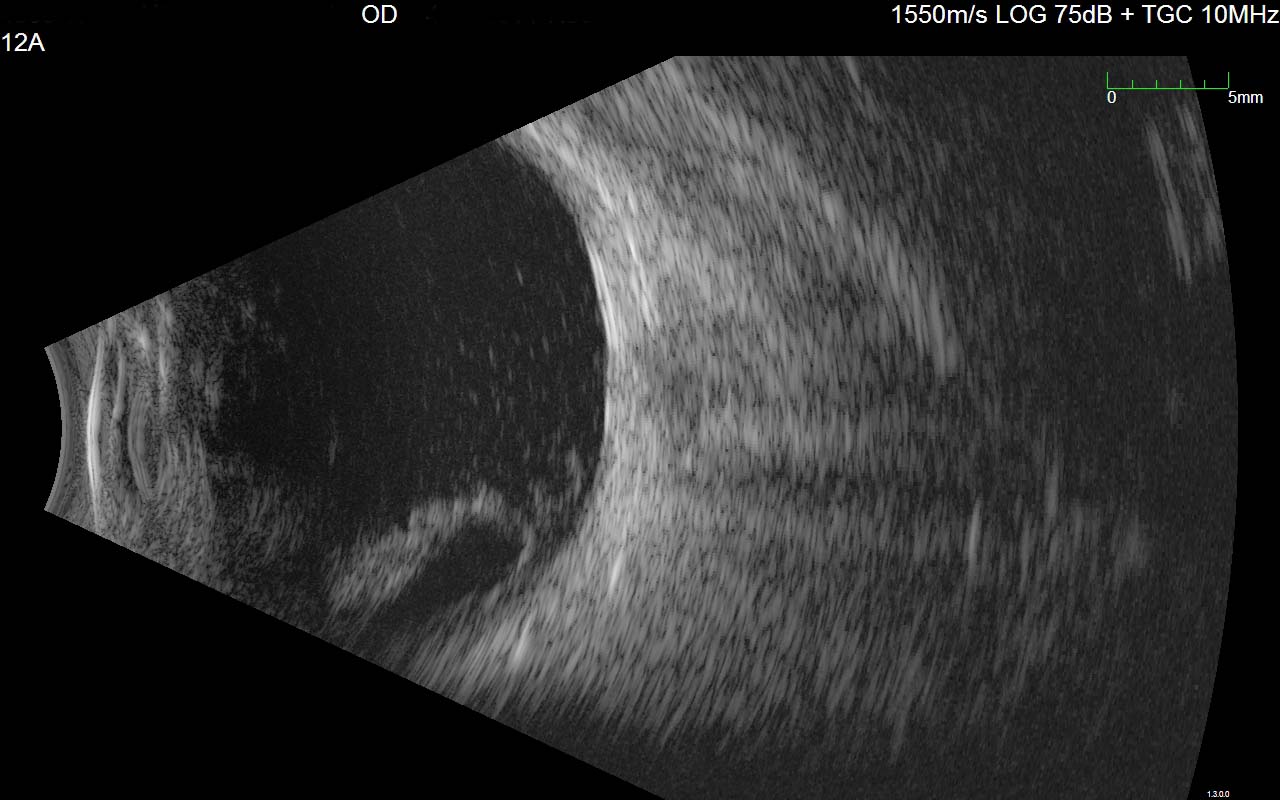 Figure 9.10.13 B-scan of a Dropped Nucleus from a Complicated Cataract Surgery