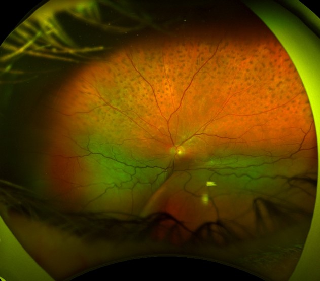 Figure 9.10.17 Wide-field Fundus Photograph of Uveal Effusion Syndrome 