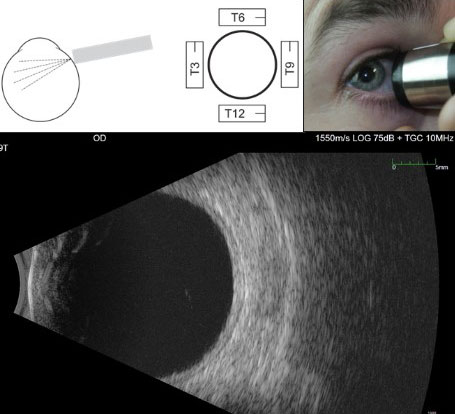 Figure 9.10.2 Transverse B-scan