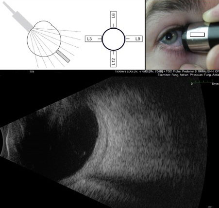 Figure 9.10.3 Longitudinal B-scan