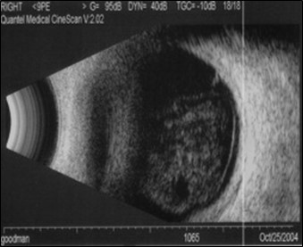 Figure 9.10.4 B-scan of Vitreous Haemorrhage Secondary to Retinal Tear
