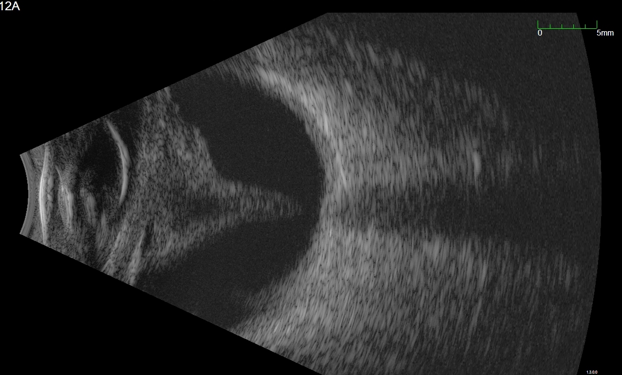 Figure 9.10.5 B-scan of a Funnel Retinal Detachment
