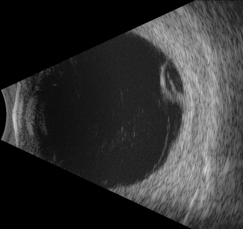 Figure 9.10.6 B-scan of Pars Plana Cyst