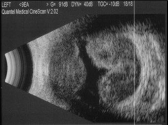 Figure 9.10.8 B-scan of Suprachoroidal Haemorrhage