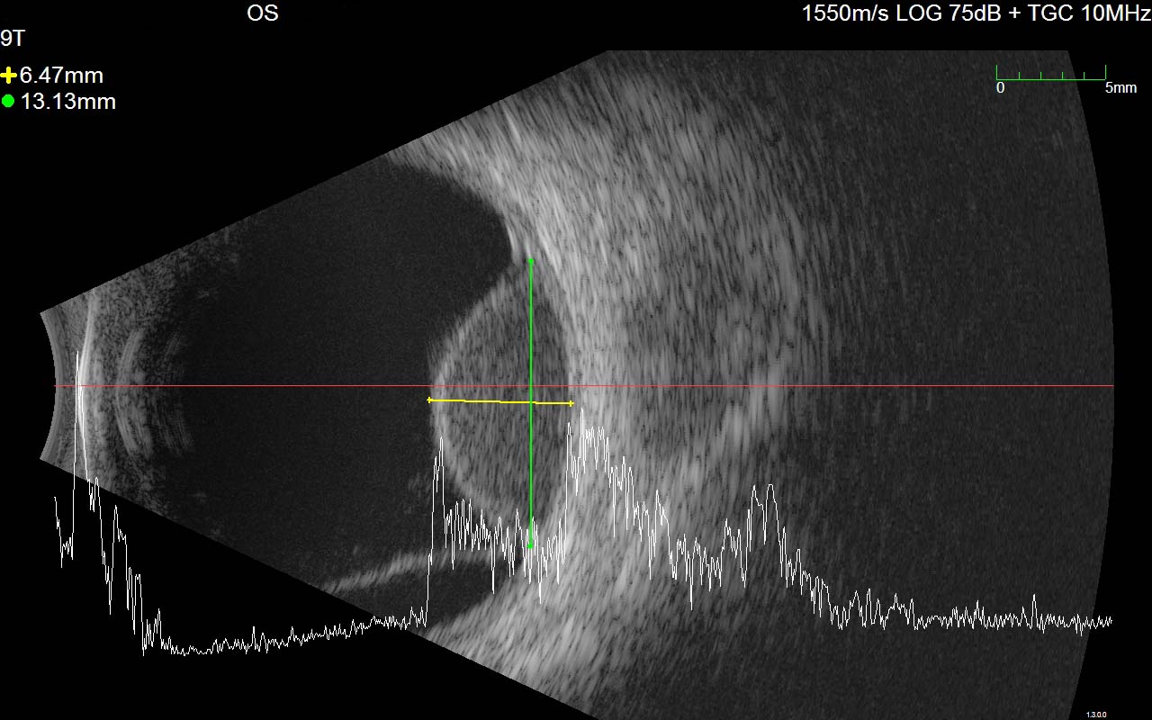 Figure 9.10.9 Simultaneous B-scan and A-scan of a choroidal melanoma