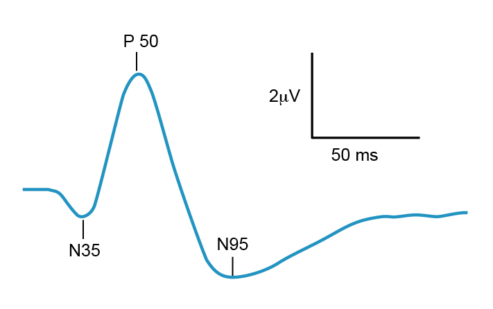 Figure 9.11.3 Typical Pattern ERG