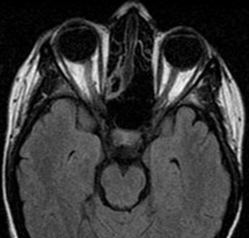 9.1.3 MRI Table - T1 Coronal