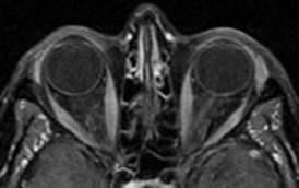 9.13 MRI Table - T1 + Gadolinium - Axial